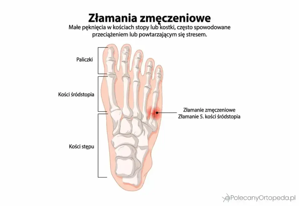 Pęknięta kość - jak rozpoznać uraz i bezpiecznie wrócić do ruchu